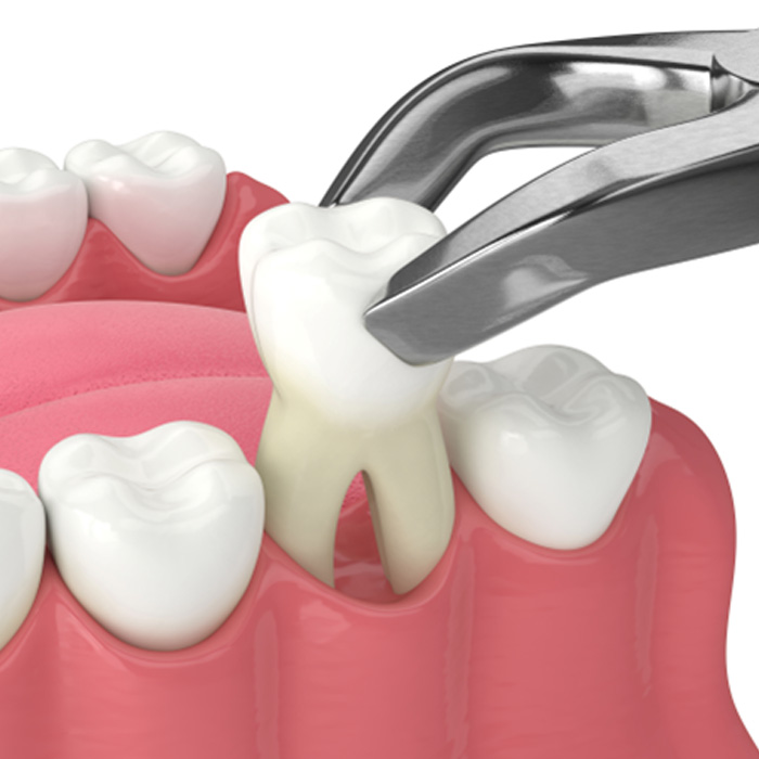 Illustration of a tooth extraction