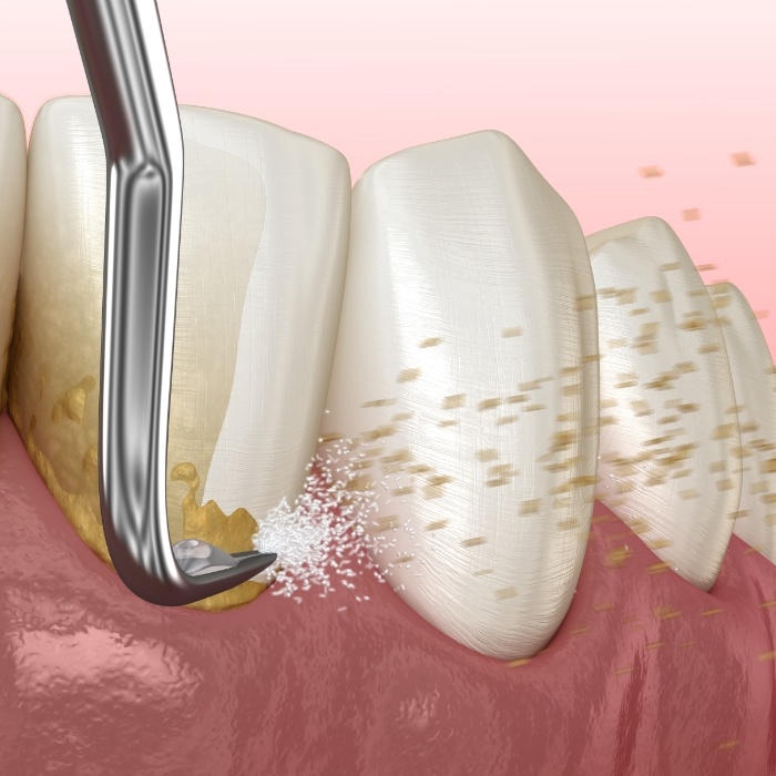 Illustrated dental instrument cleaning tartar buildup from teeth