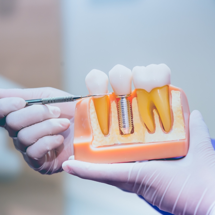 Dentist holding a model of a dental implant in Plattsburgh