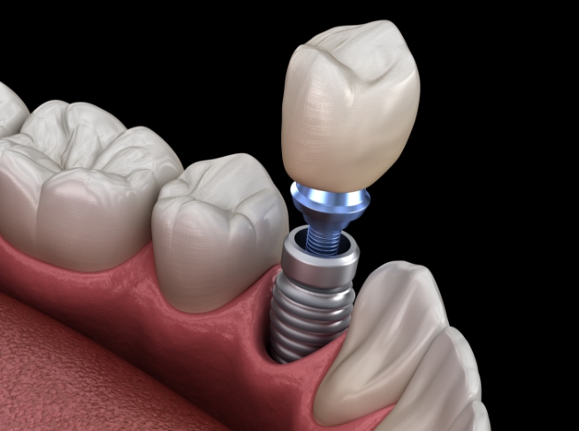 Illustrated dental crown being fitted onto a dental implant