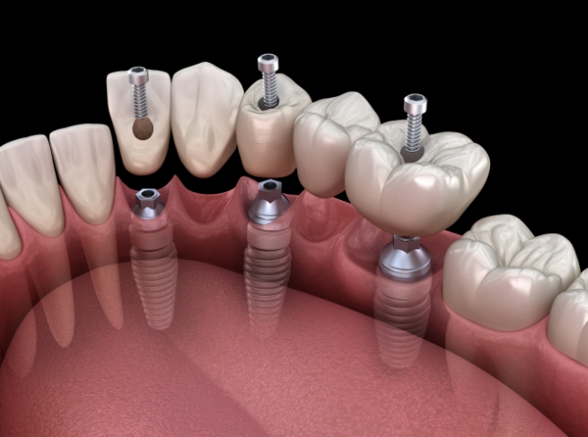 Illustrated dental bridge being fitted onto three dental implants