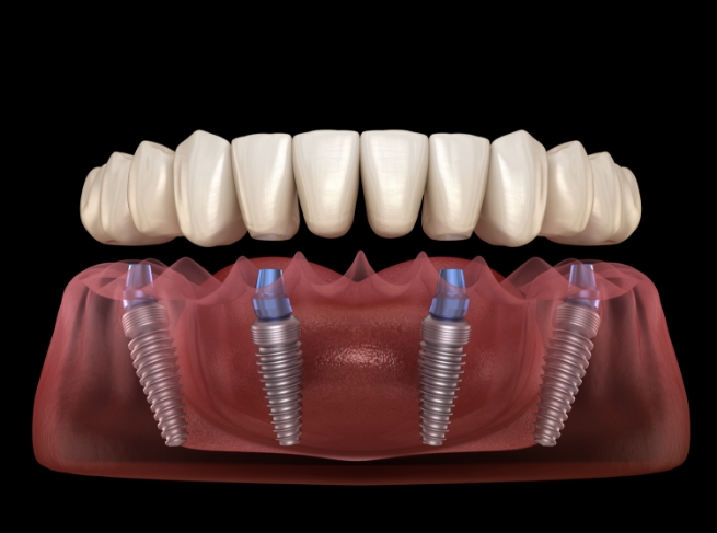 Illustrated full denture being fitted onto four dental implants