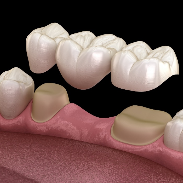 Illustrated dental bridge being fitted to replace a missing tooth in Plattsburgh