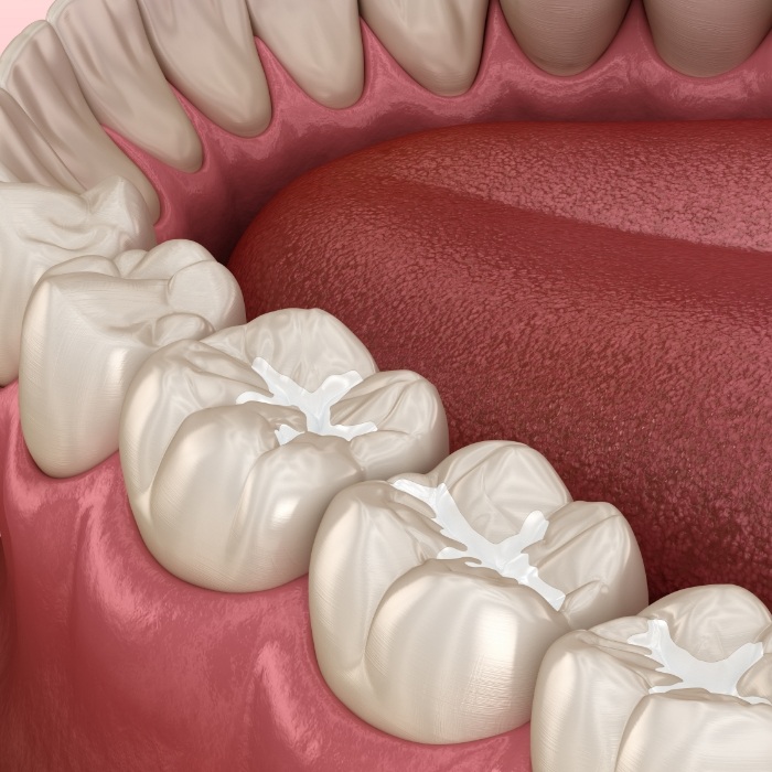 Illustrated row of teeth with dental sealants