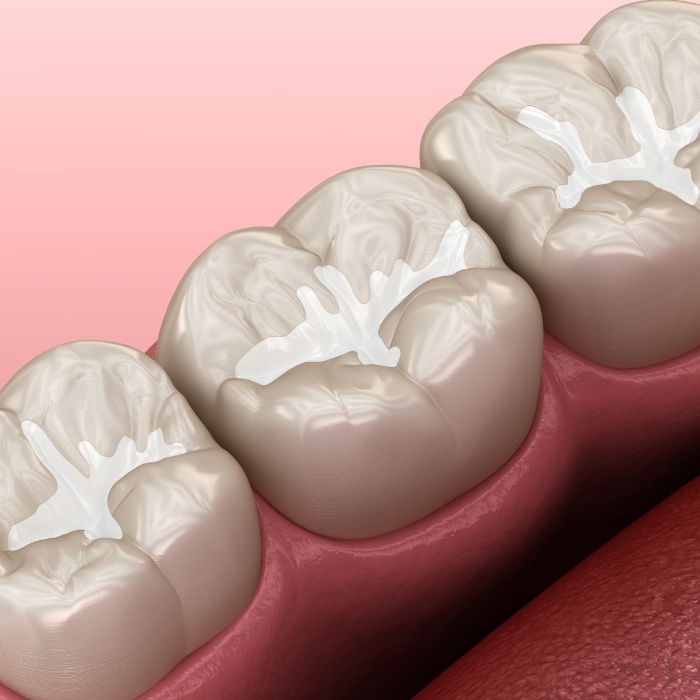 Illustrated row of teeth with white fillings