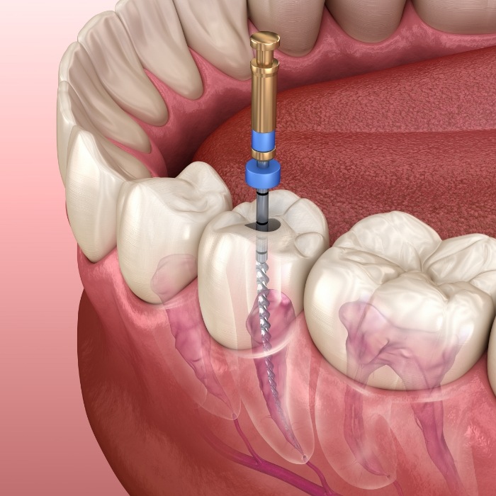 Illustrated dental instrument cleaning the inside of a tooth