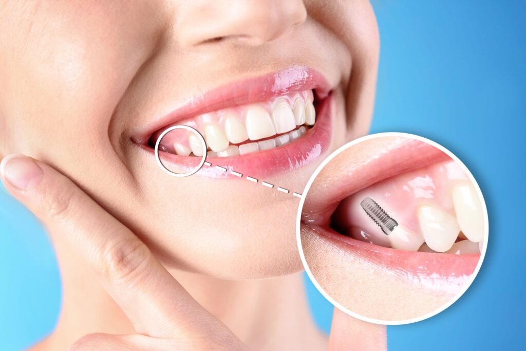 Nose-to-neck image of woman smiling with one tooth indicated as an implant