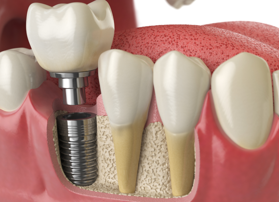 3D image of a dental implant