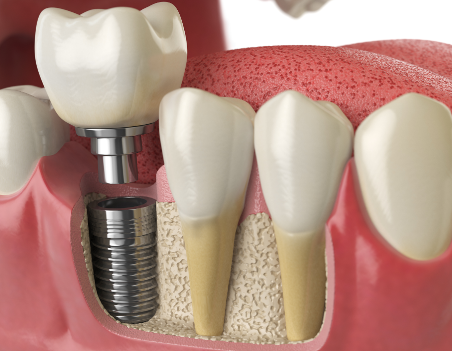 3D image of dental implant